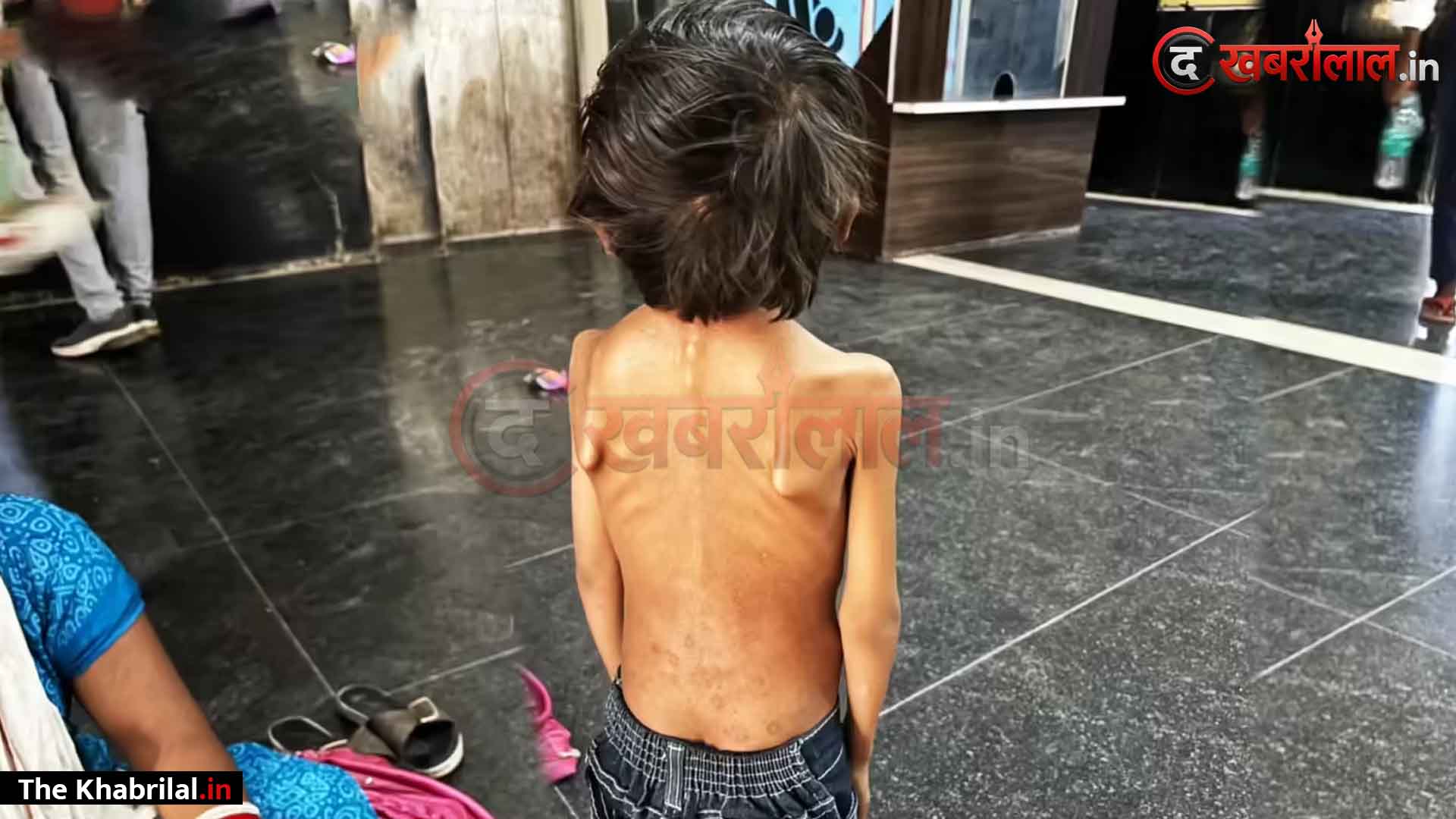 सिस्टम को झकझोरती तस्वीर: 5 साल की उम्र में हड्डियों का ढांचा बना मासूम पवन, कई इलाज बेअसर होने पर मैहर अस्पताल में भर्ती; डॉक्टर बोले—’जन्मजात विकृति’